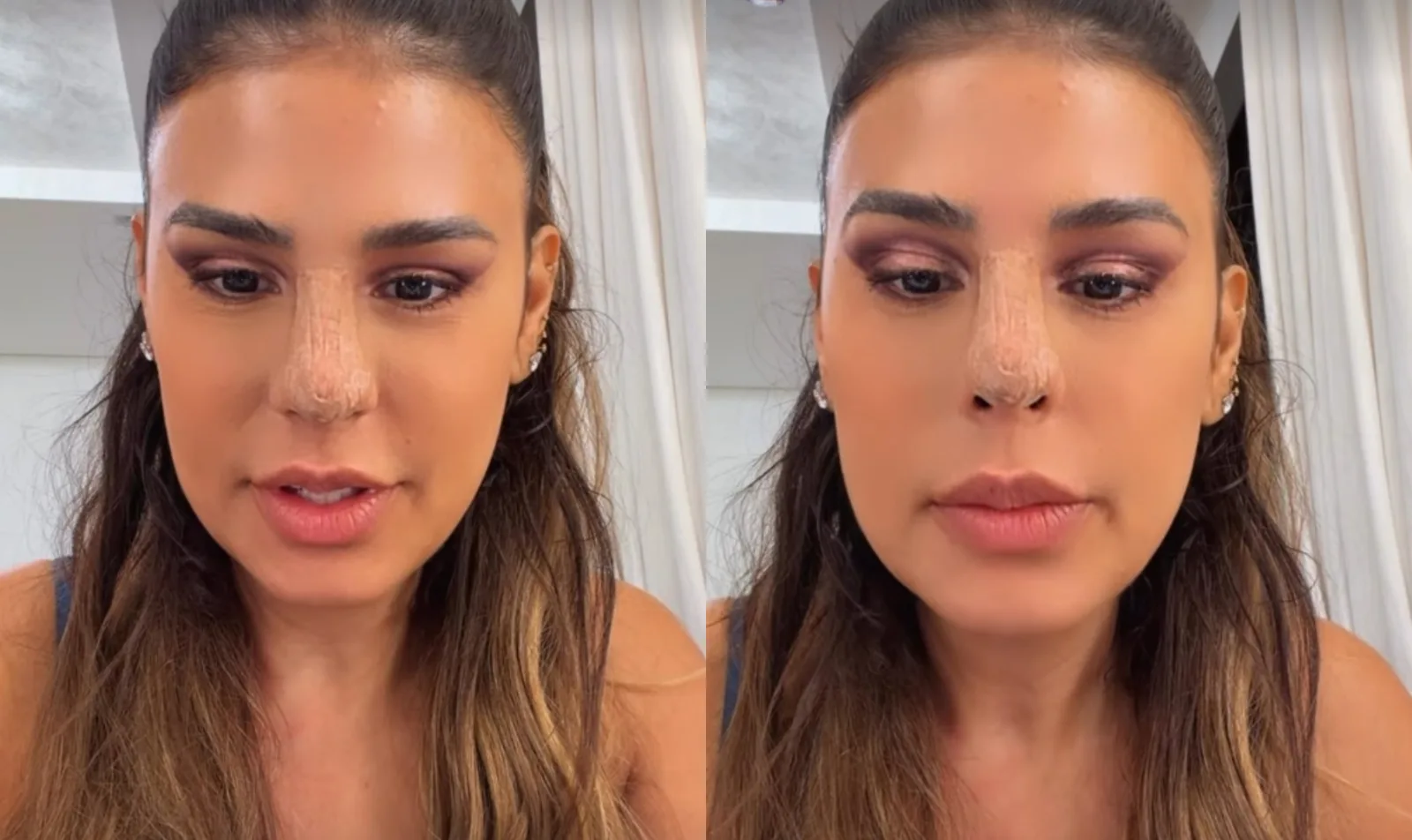 Simone Mendes fala sobre inchaço e recuperação após procedimento no nariz