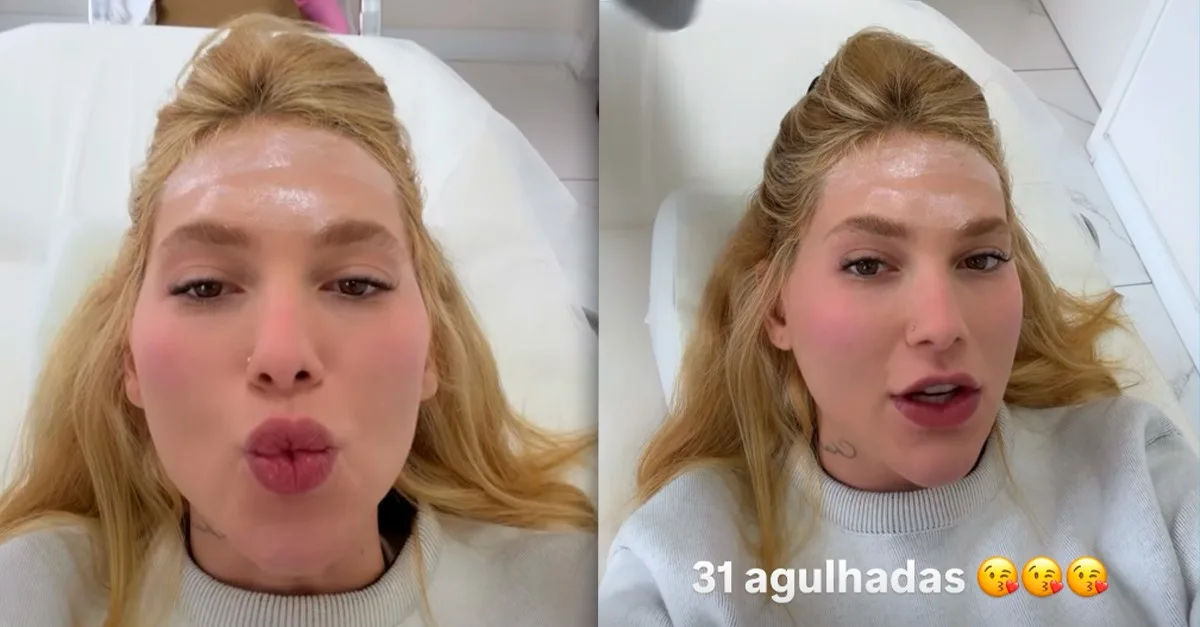 Virginia Fonseca faz 31 aplicações na cabeça para tratar enxaqueca