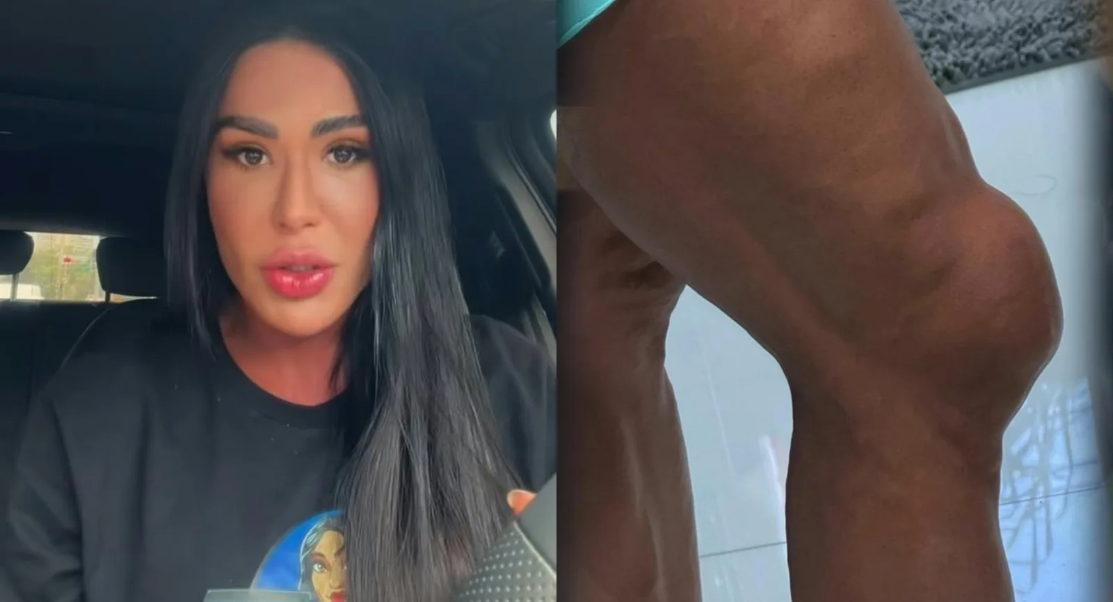 Gracyanne relata limitações e faz punção no joelho durante retorno ao Dança