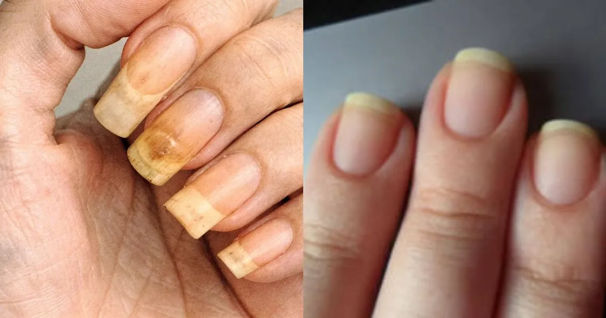 O que observar antes de usar vinagre em unhas amareladas