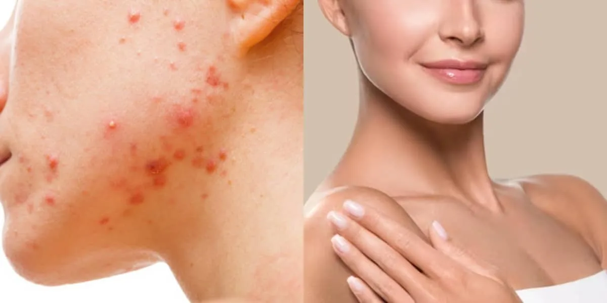 Sérum da Noviole combina ativos para acne, oleosidade e manchas