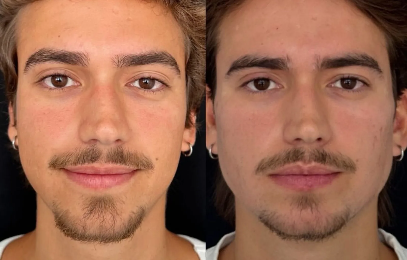 Henrique Meinke mostra resultado de harmonização facial após segunda sessão